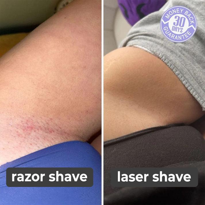 Épilateur laser